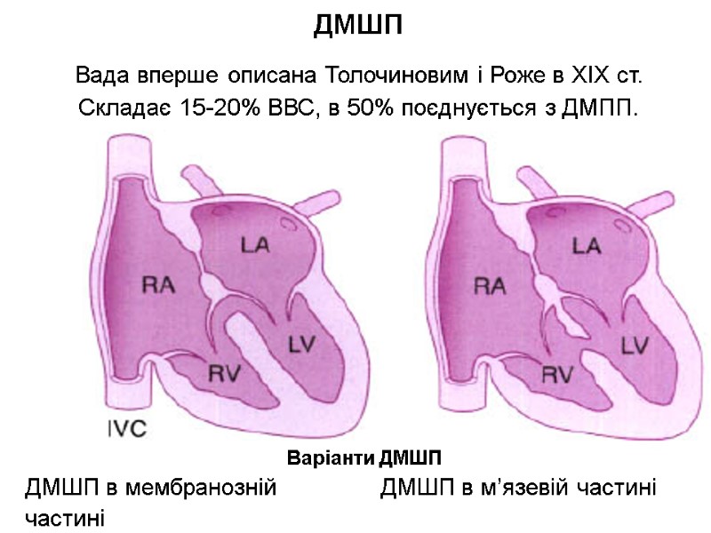 ДМШП Вада вперше описана Толочиновим і Роже в XIX ст. Складає 15-20% ВВС, в
